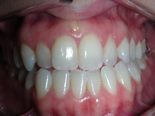 Orthodontic case study 4 - before image