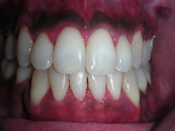 Orthodontic case study 5 - after image