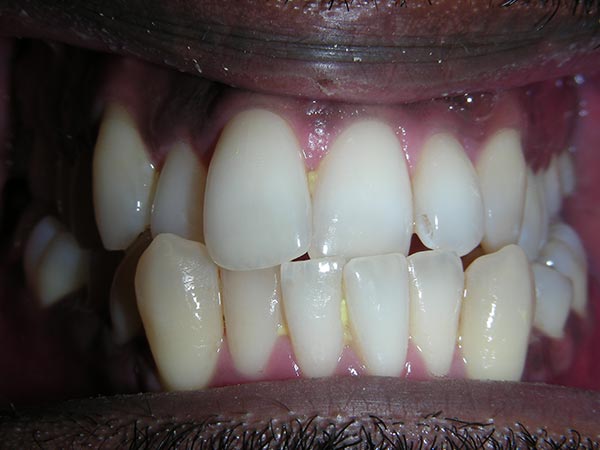 Orthodontic case study 5 before image