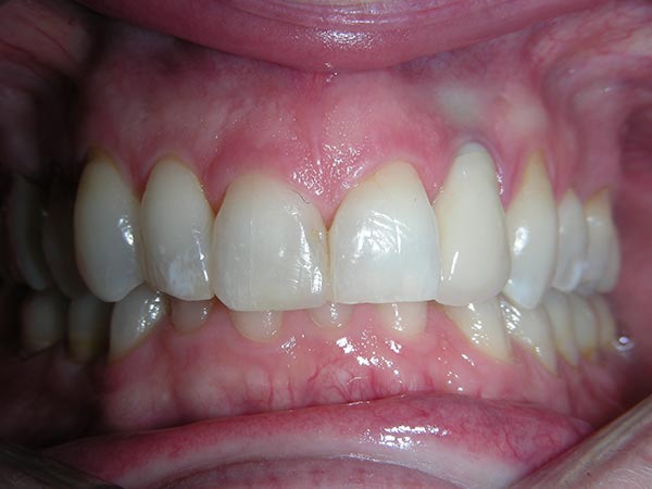 Orthodontic case study 6 - after image