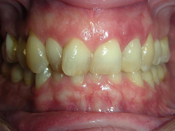 Orthodontic case study 6 - before image