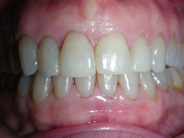 Orthdontic case study 7 - after image